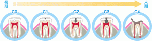 虫歯進行のC1～C4 背景白　tdt_img02