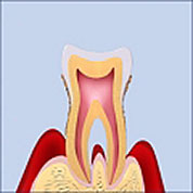 歯周病の進行Ｐ1からＰ４