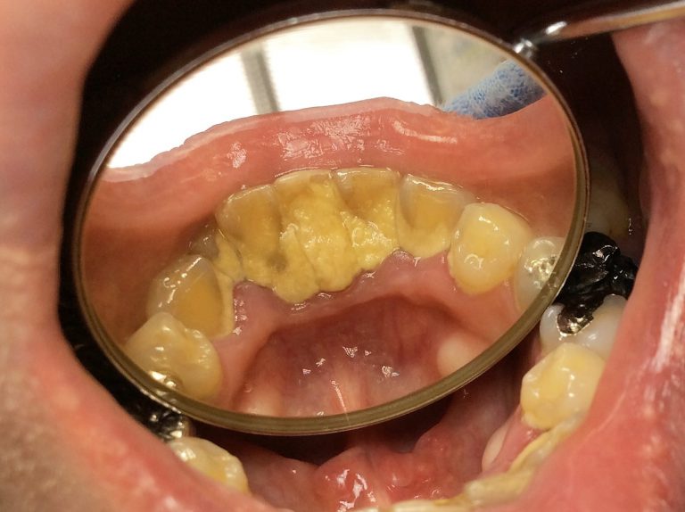 歯 の 歯石 を 取る 方法 – 入れ歯の歯石を取る方法